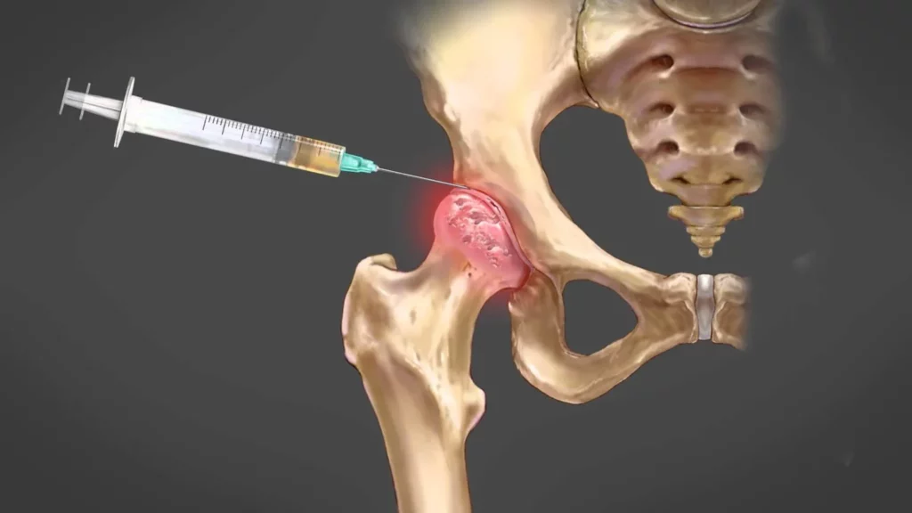Hip Osteoarthritis Hyaluronic Acid Injection
